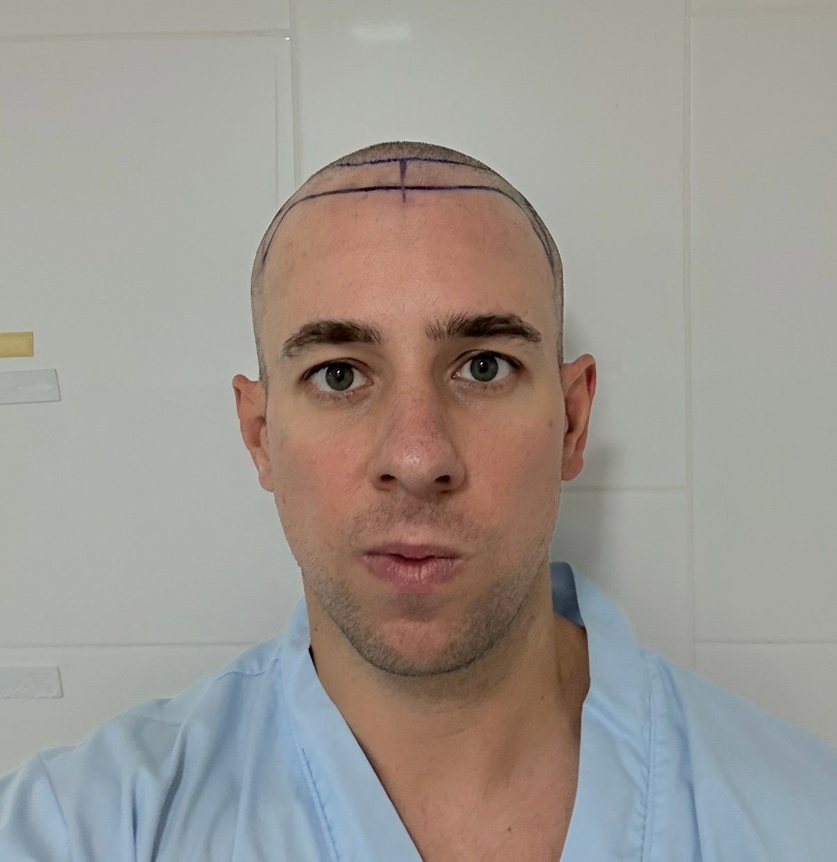 2170 Grafts Hair Transplant Before