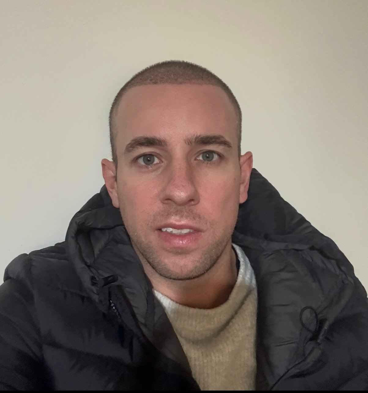 2170 Grafts Hair Transplant Day 7 After