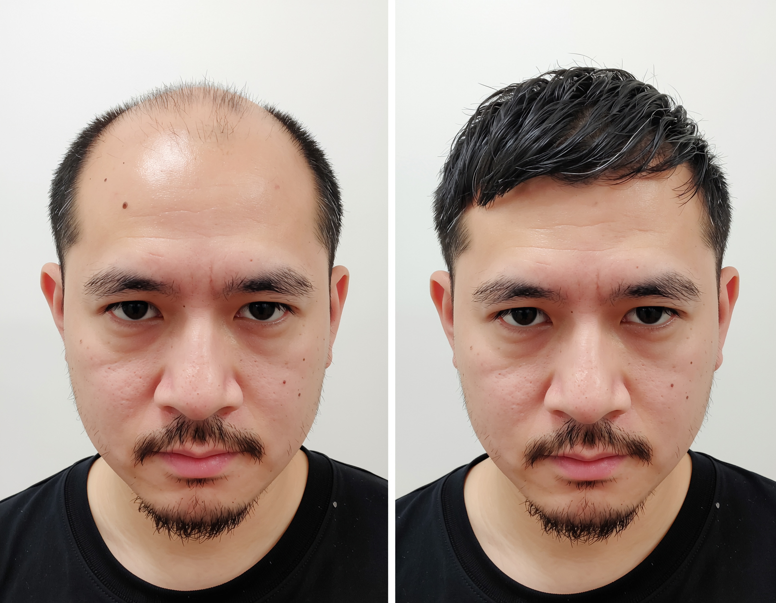 5000 Grafts Hair Transplant Before and After